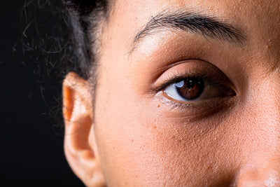 How Can I Reduce Dark Circles Under My Eyes?
